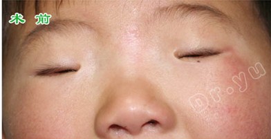 小睑裂综合征手术矫正